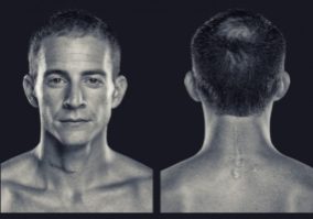 picture of man looking at camera and back showing off scar from spinal surgery