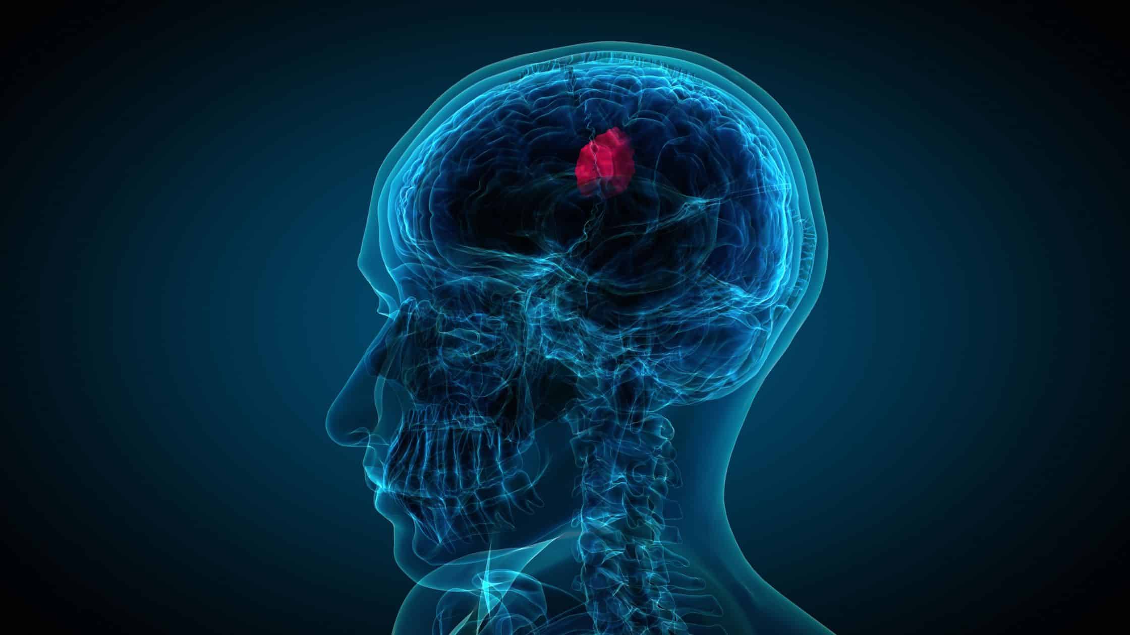 Brain Tumor and Skull Base Surgery