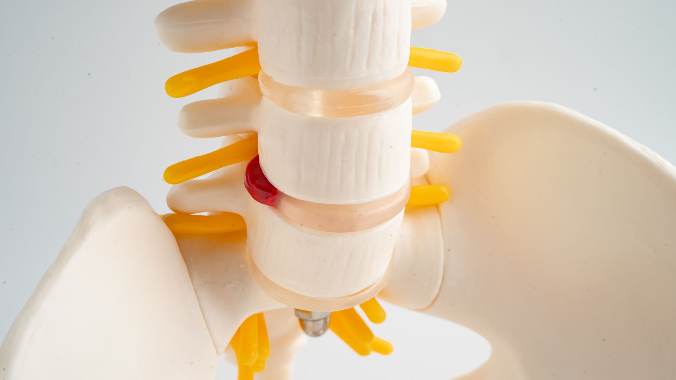 Artificial Disc Replacement